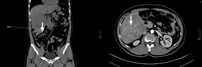 Hình ảnh khối máu tụ dưới gan (trái, vị trí mũi tên) và khối u gan lớn trên CT bụng bệnh nhân (phải).  Ảnh: Bệnh viện cung cấp