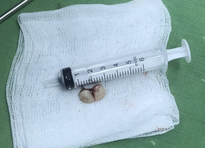 Hai chiếc răng giả mắc kẹt trong phế quản của bệnh nhân.  Ảnh: Bệnh viện cung cấp